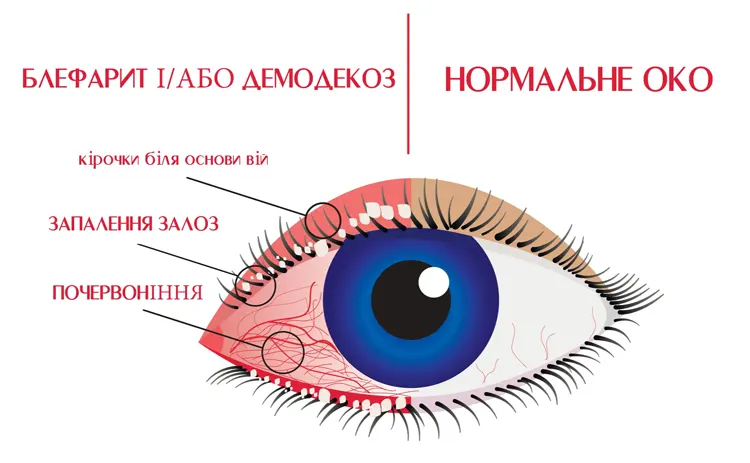 Порівняння нормального стану ока і ока, яке хворе на блефарит або/та демодекоз.